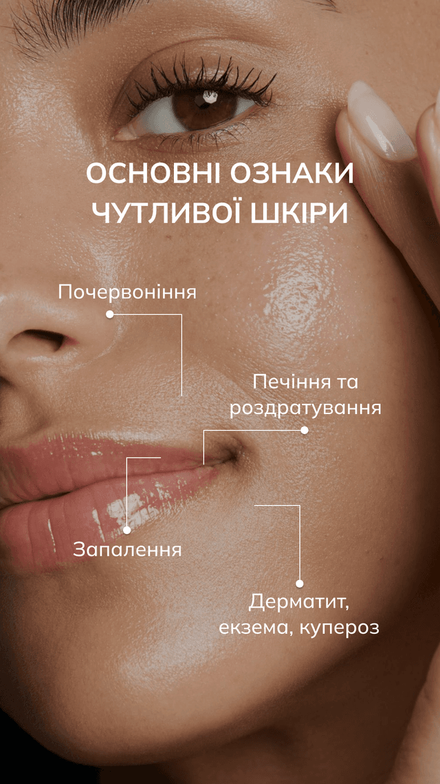Ознаки чутливої шкіри — інфографіка для косметолога